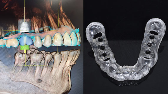 Dental 3d modeling and printing