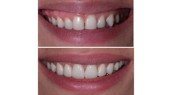 Cosmetic periodontal surgery 