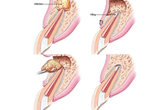 Apicoectomy illustration